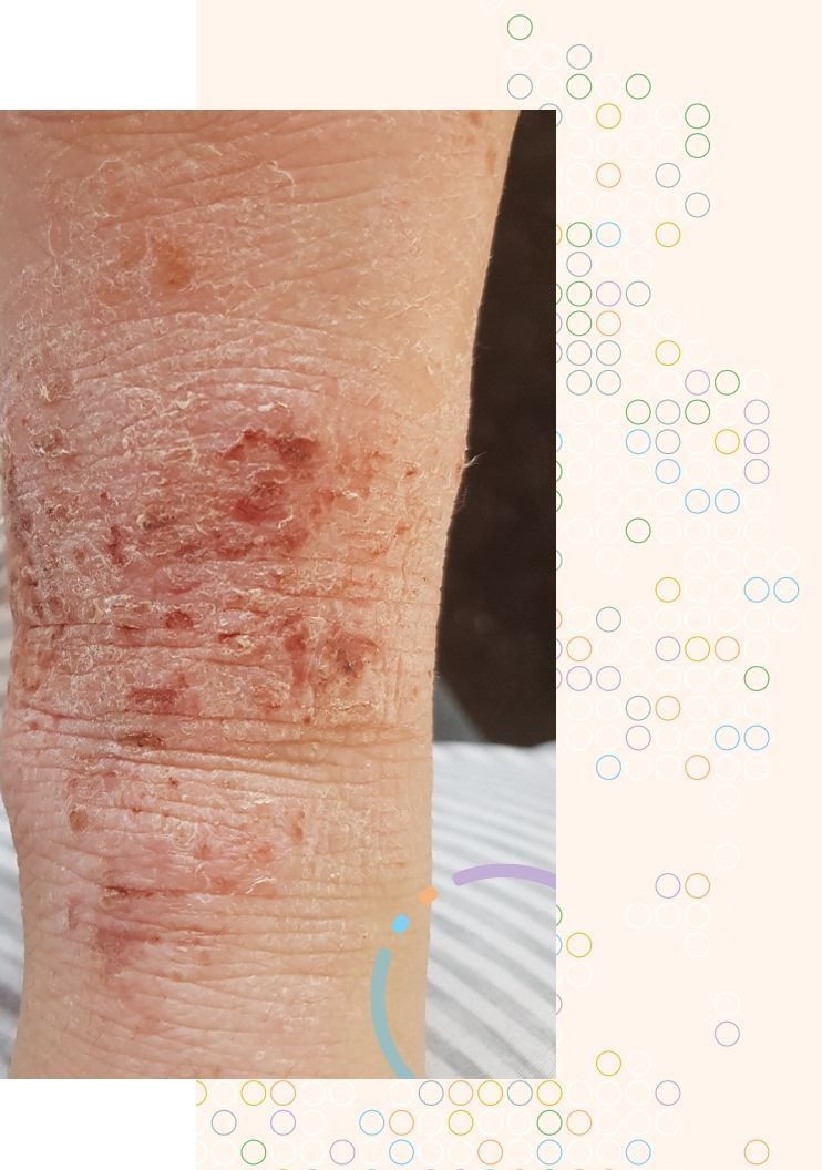 What is atopic dermatitis? | Global atopic dermatitis atlas